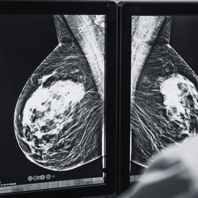 Breast Scans :do doctors tell you right away if you have cancer